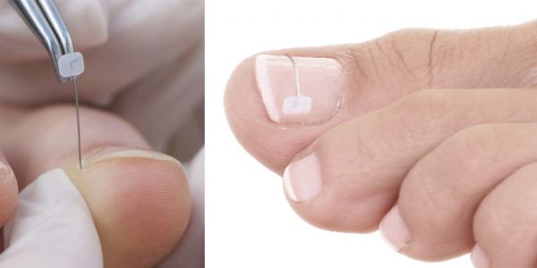 Imagem do tratamento conservador (substituir)