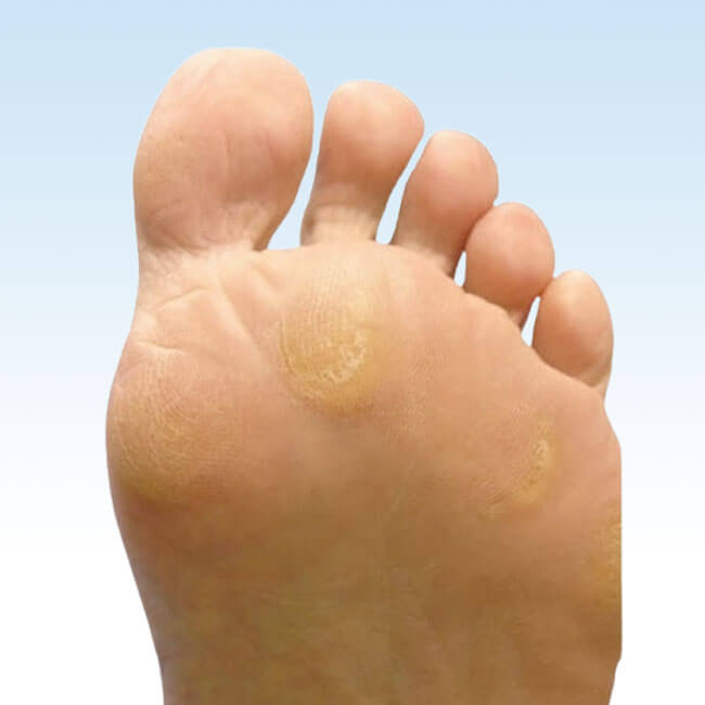 Calosidades e hiperqueratoses